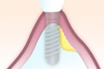 GBR法